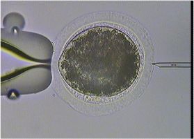 Microscope image of intracytoplasmic sperm injection (ICSI) procedure
